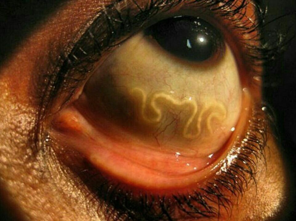 insan gözündeki parazitler